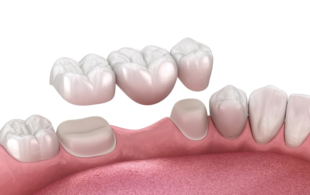 Dental Bridges in Winchester