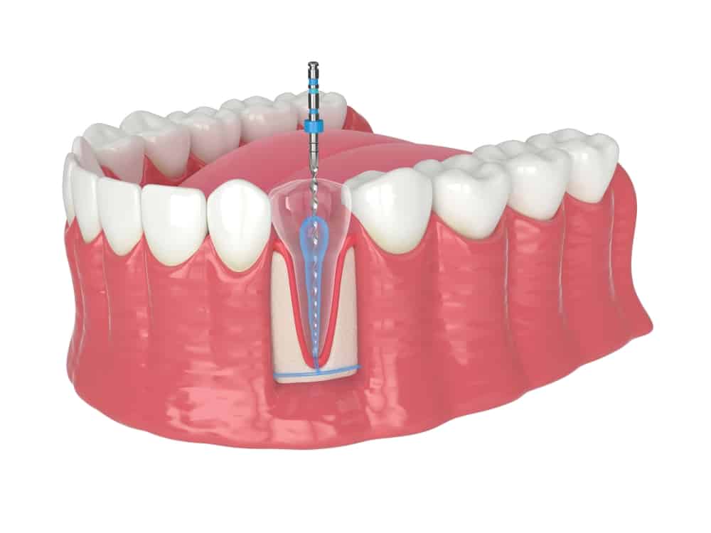 Root Canal in Winchester