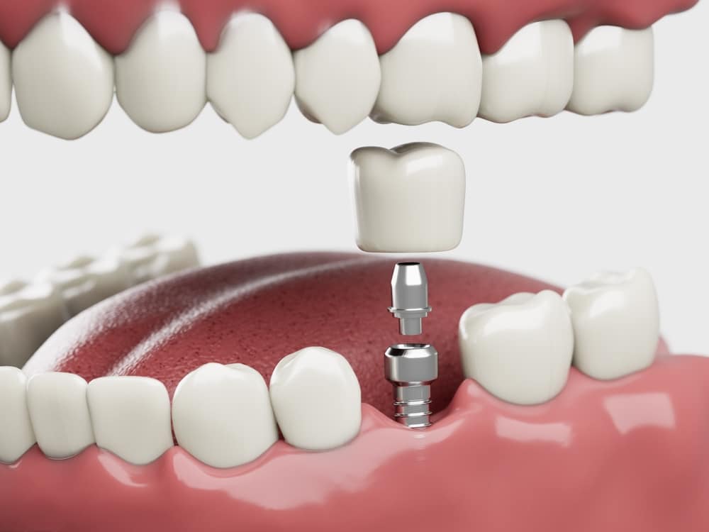 Dental implants in Winchester